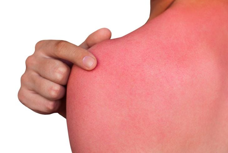 Riconoscere e trattare un'allergia al sole 5
