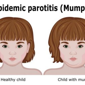 Cause e trattamenti della parotite Cause e trattamenti della parotite