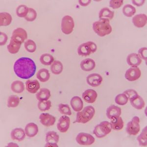 Che cos’è la biopsia del midollo osseo? Che cos’è la biopsia del midollo osseo?