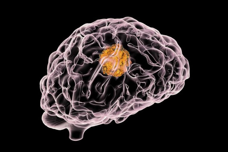 Idrocefalo: eccesso di liquido cerebrospinale nel cervello 11