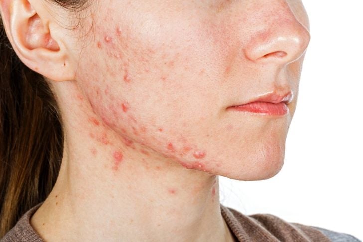 Da lievi a gravi: 10 infezioni batteriche della pelle da conoscere 5