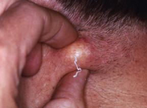 Cisti sebacee Cisti sebacee