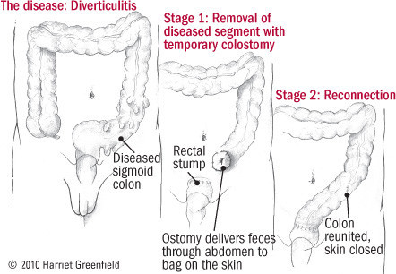 Diverticolosi e diverticolite 4 Diverticolosi e diverticolite 3