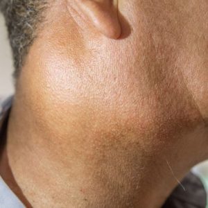 7 sintomi del cancro della ghiandola salivare