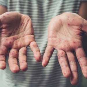10 Sintomi e trattamenti dei geloni 10 Sintomi e trattamenti dei geloni