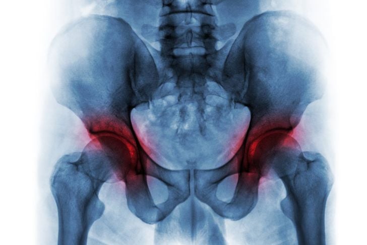 10 domande frequenti sulla displasia dell'anca 3