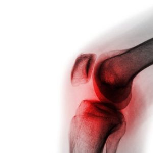 Domande frequenti sull’artrite settica