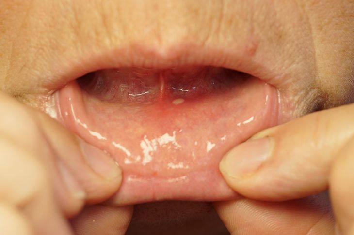 10 Sintomi e trattamenti principali della sindrome della bocca secca 19