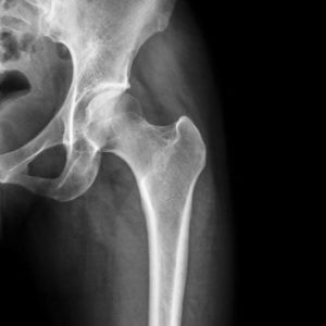 10 fatti sull’impingement dell’anca 10 fatti sull’impingement dell’anca