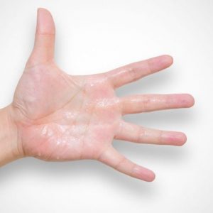 10 Sintomi dell’iperidrosi 10 Sintomi dell’iperidrosi