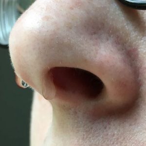 Cause e rimedi del gocciolamento post-nasale