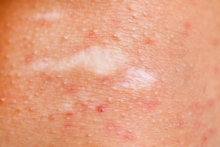 Da lievi a gravi: 10 infezioni batteriche della pelle da conoscere 3