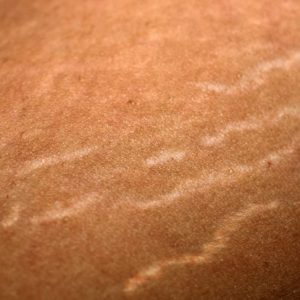Quali sono le cause delle smagliature? Quali sono le cause delle smagliature?