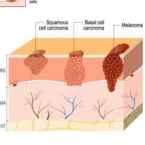 Che cos’è il carcinoma a cellule squamose? Che cos’è il carcinoma a cellule squamose?