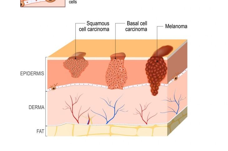 Che cos'è il carcinoma a cellule squamose? 1