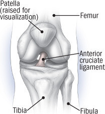 Lesioni del legamento crociato anteriore (ACL) Lesioni del legamento crociato anteriore (ACL)