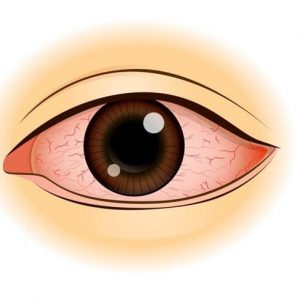 Che cos’è un’ulcera corneale?