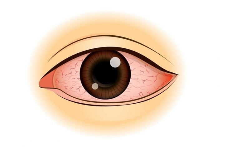 Che cos'è un'ulcera corneale? 1