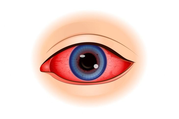 L'uveite è una malattia oculare grave che si maschera da malattia minore 5