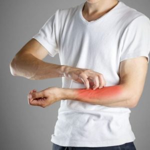 10 domande frequenti sulla Prurigo Nodularis 10 domande frequenti sulla Prurigo Nodularis