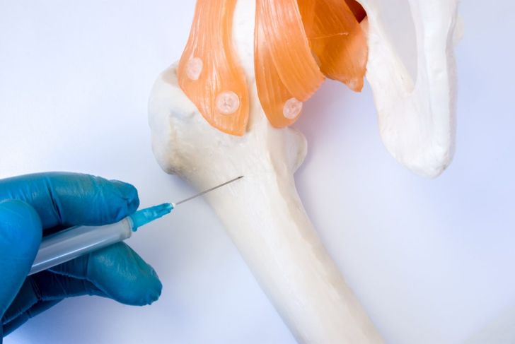 10 fatti importanti sull'osteomalacia 11