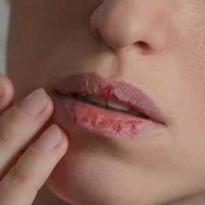 10 Sintomi e trattamenti principali della sindrome della bocca secca 10 Sintomi e trattamenti principali della sindrome della bocca secca