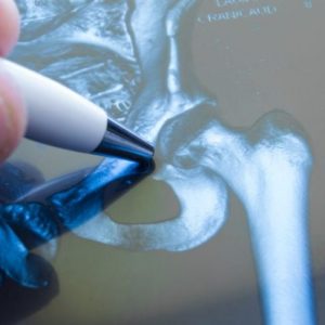 Domande frequenti sull’impingement femoroacetabolare Domande frequenti sull’impingement femoroacetabolare