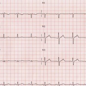Che cos’è un elettrocardiogramma? Che cos’è un elettrocardiogramma?
