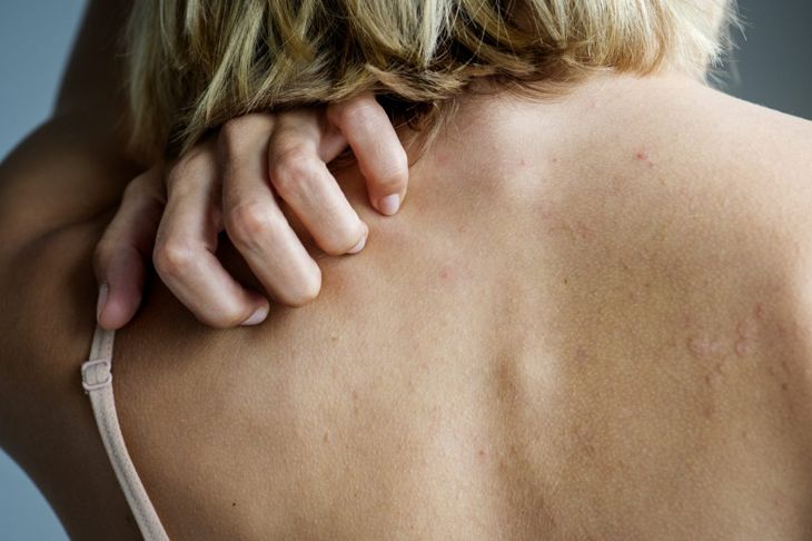 Cause, sintomi e trattamento dell'eczema nummulare 3