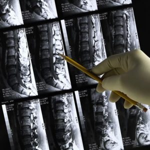 Cause, sintomi e trattamenti della frattura da compressione Cause, sintomi e trattamenti della frattura da compressione