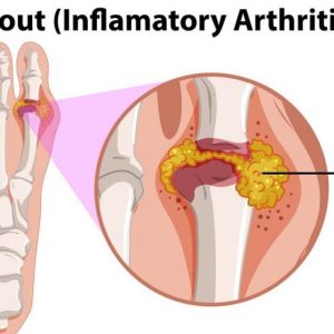 Qual è la differenza tra artrite reumatoide e gotta?