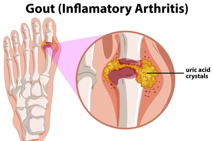 Qual è la differenza tra artrite reumatoide e gotta? 1