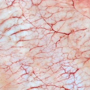 Che cos’è l’emangiopericitoma? Che cos’è l’emangiopericitoma?