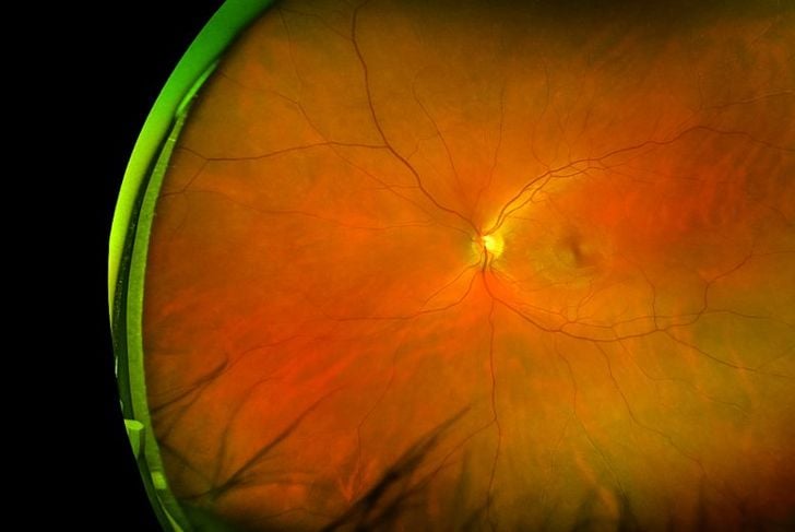Che cos'è la retinite pigmentosa? 5