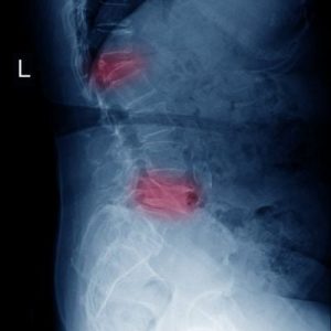 Trattamenti per la spondilite anchilosante