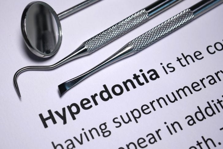 Hyperdontia: Are Extra Teeth a Problem? 1