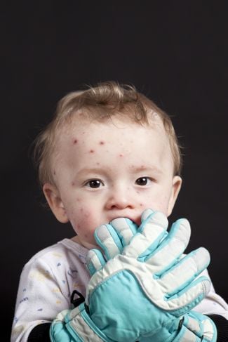 Che cos'è la varicella? Sintomi e trattamento 11