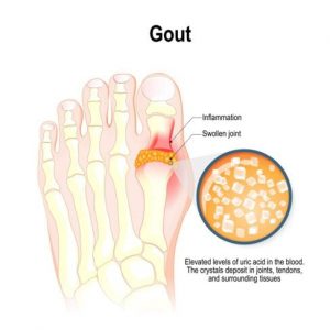 Trattamento della gotta Trattamento della gotta