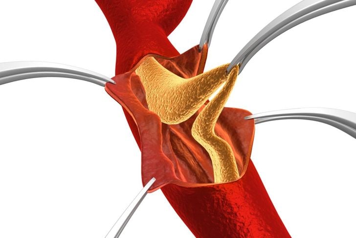 Capire la stenosi dell'arteria carotidea 17
