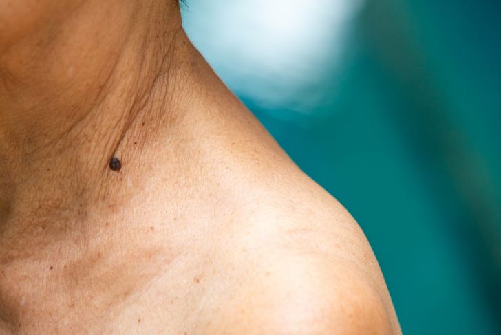 10 segni di cancro della pelle 3