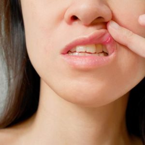 Trattamento dell’ulcera della bocca