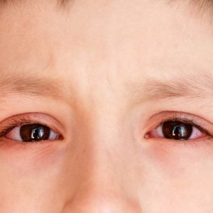Infezioni oculari comuni e come trattarle
