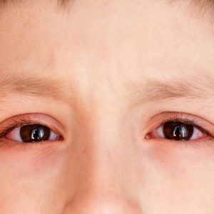 Infezioni oculari comuni e come trattarle Infezioni oculari comuni e come trattarle