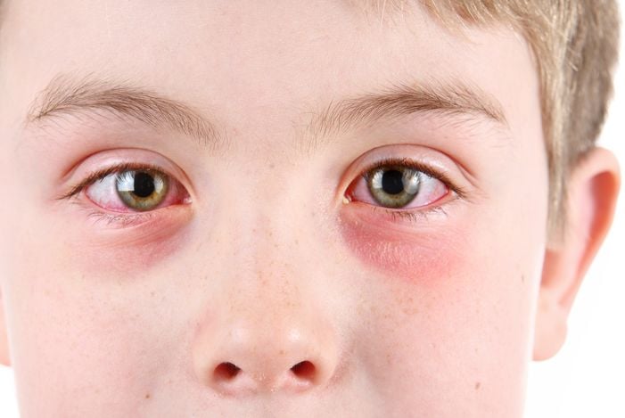 Infezioni oculari comuni e come trattarle 13