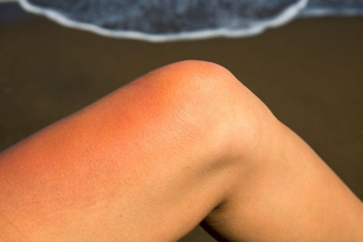 10 segnali di allarme di un coagulo di sangue nella gamba 3