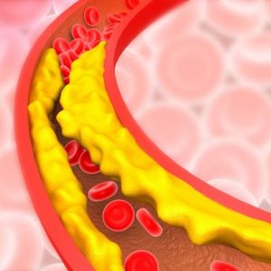 Comprendere e combattere l’arteriosclerosi Comprendere e combattere l’arteriosclerosi