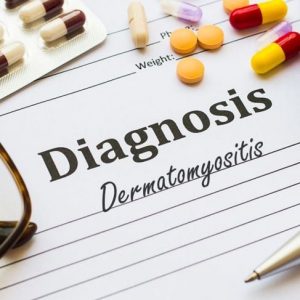 Che cos’è la dermatomiosite?