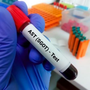 Capire gli esami del sangue AST e i loro risultati