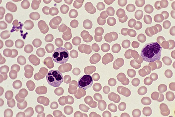 Pancitopenia, midollo osseo e conta delle cellule del sangue 5