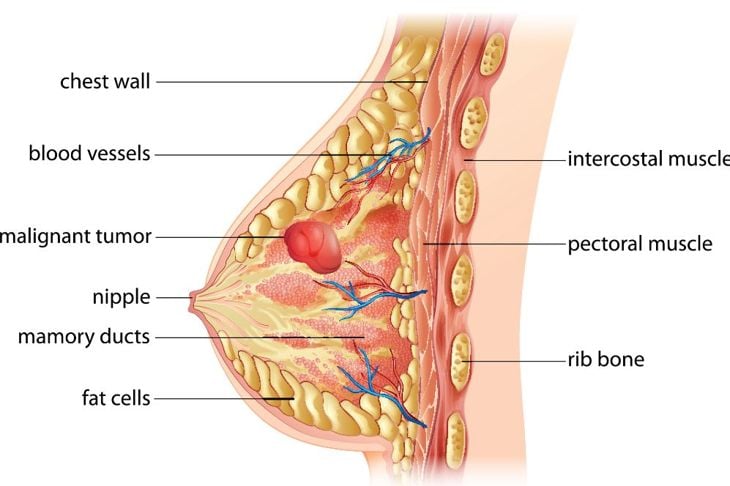 Domande frequenti sui noduli al seno 9